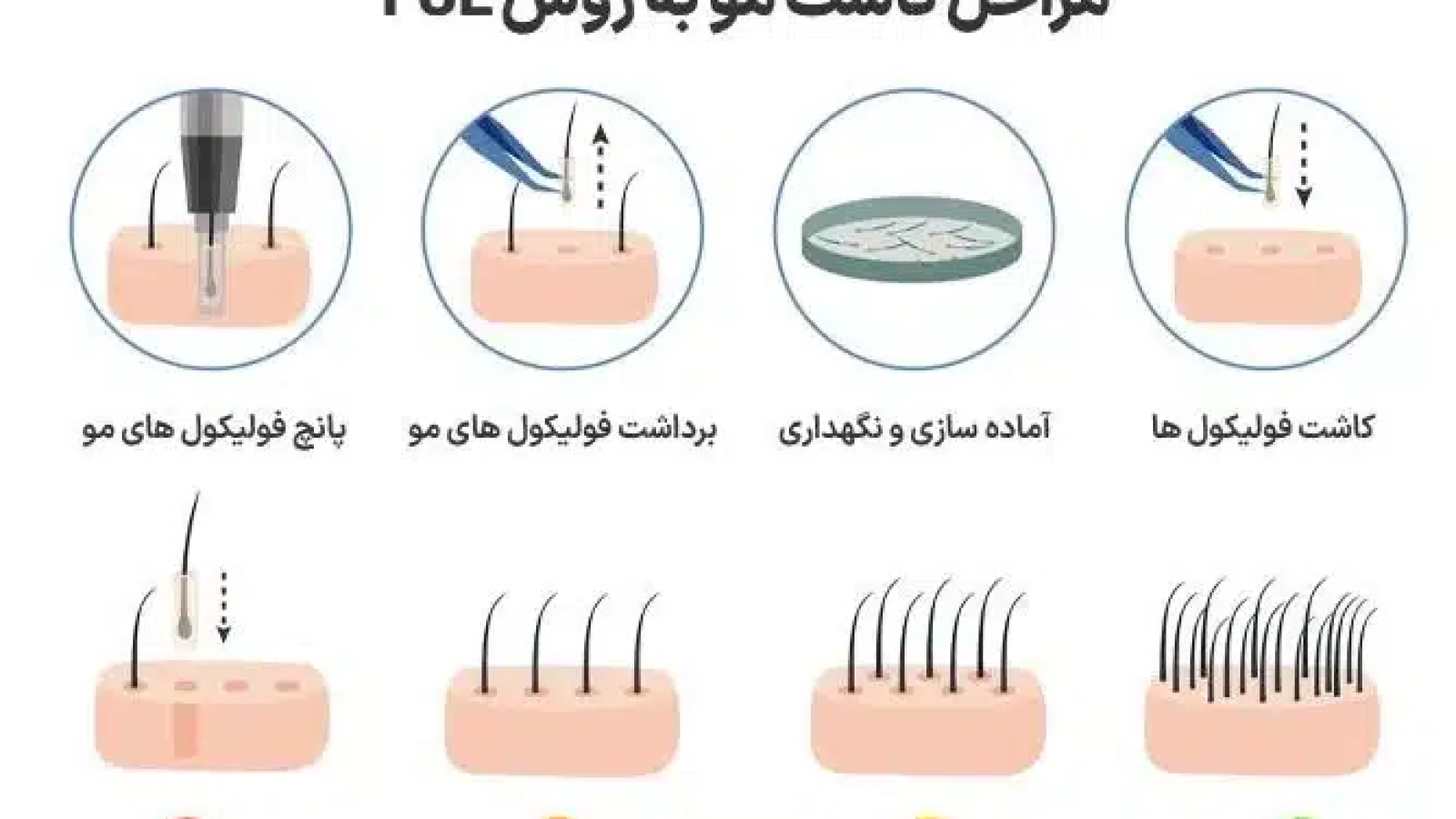 کاشت مو به روش